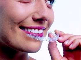 KopievonInvisalign2gro.jpg